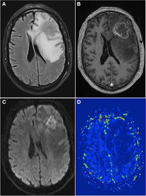 Frontiers | Brain Radiation Necrosis: Current Management With a Focus